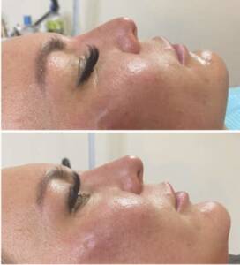 12 point Dermafiller client 1