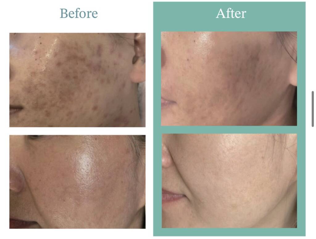 Xoma skin before after