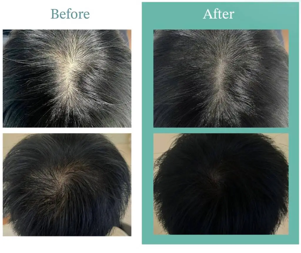 XOMAGE HAIR RESTORATION BEFORE AFTER