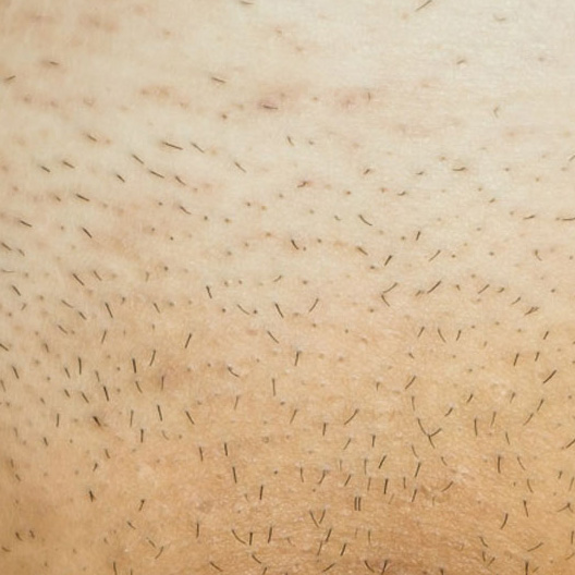 before alilus hair removal